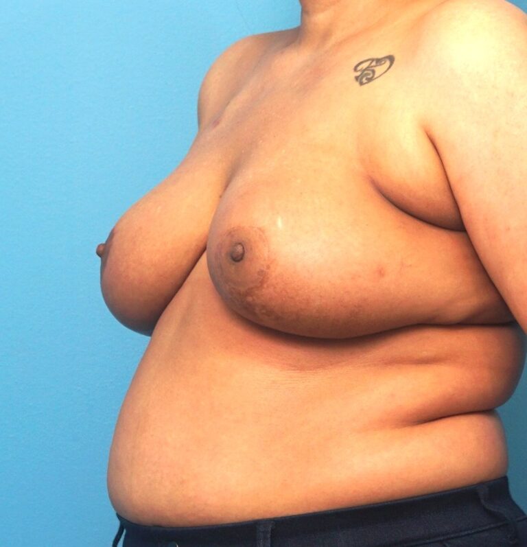 After Image: Breast Reconstruction – Oncoplastic Breast Reduction - left-front-oblique