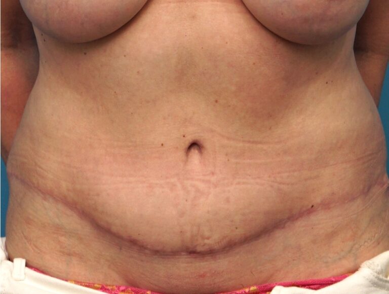 After Image: Tummy Tuck (Abdominoplasty) - front