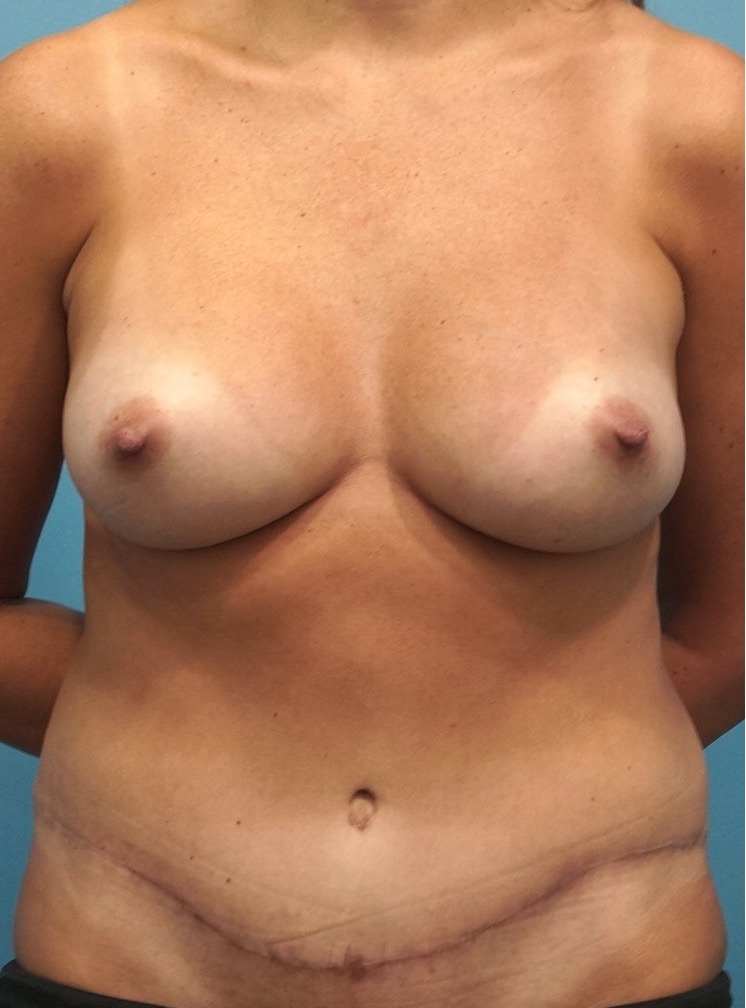 After Image: Mommy Makeover (Breast Augmentation and Tummy Tuck) - front