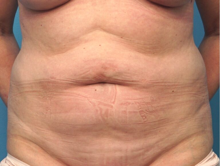 Before Image: Tummy Tuck (Abdominoplasty) - front