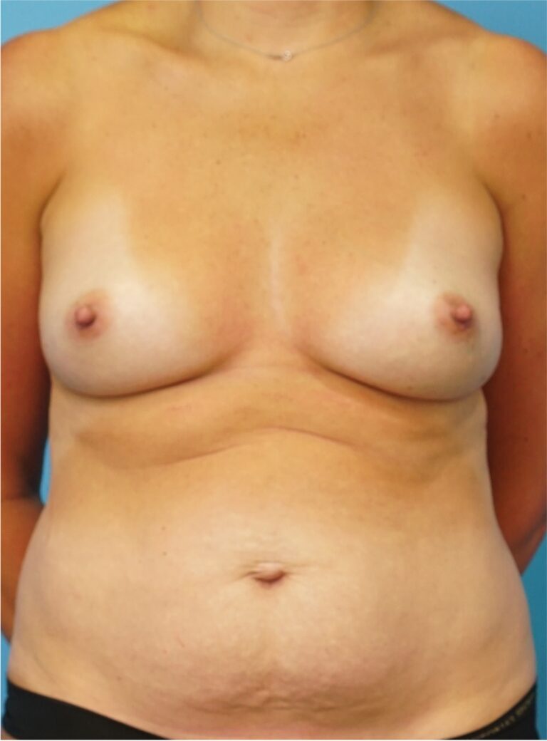 Before Image: Mommy Makeover (Breast Augmentation and Tummy Tuck) - front