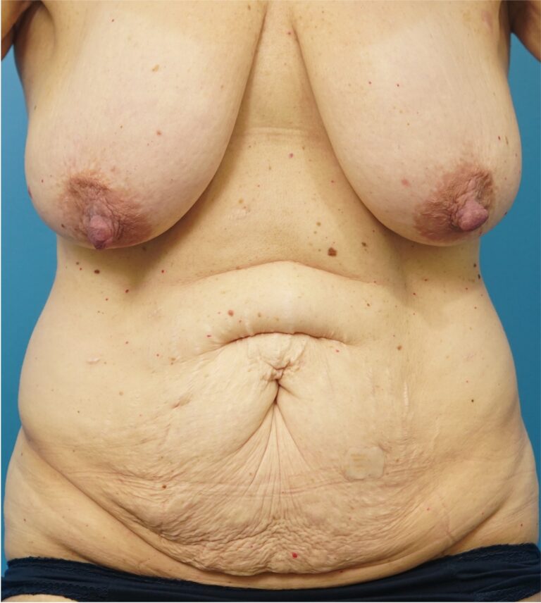 Before Image: Mommy Makeover (Breast Reduction and Tummy Tuck) - front