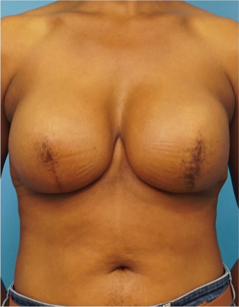 After Image: Breast Reconstruction – Implants - front