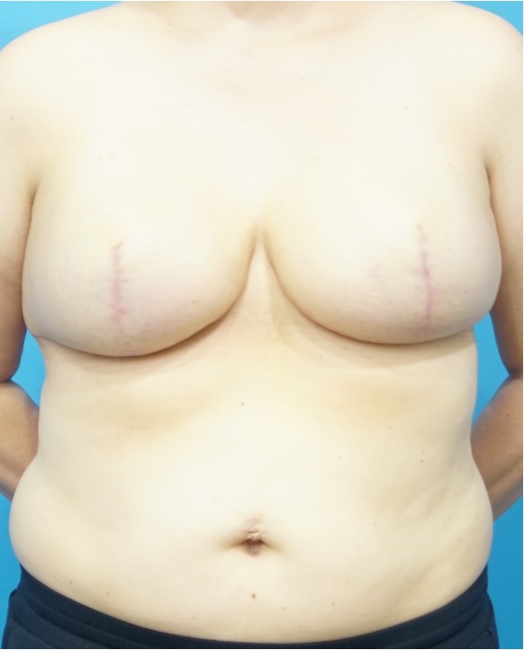 After Image: Breast Reconstruction – Implants - front